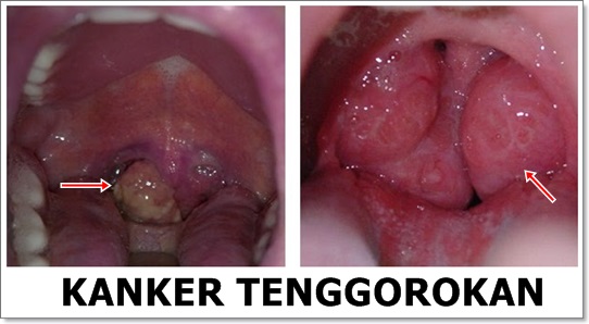 Obat Herbal Kanker Tenggorokan Tanpa Operasi Bisa Bayar